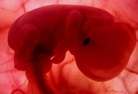 Aborto selettivo. Nel ricco e cattolico nord est 7 donne su 10 abortiscono i figli down: il caso di Treviso